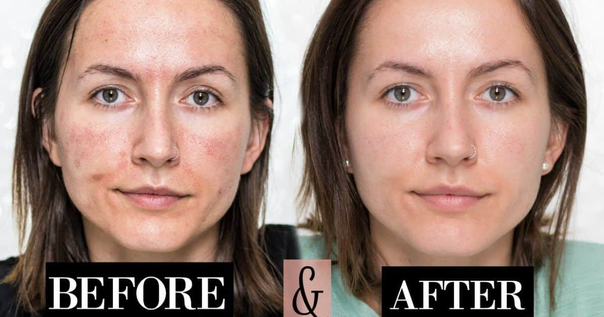 Can You Wear Makeup After Microneedling?