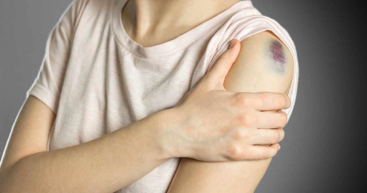 How to Cover up a Bruise on Arm Without Makeup?