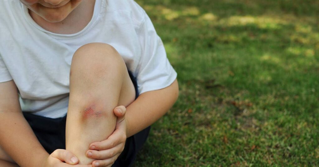 Understanding Bruises: Causes and Healing Process