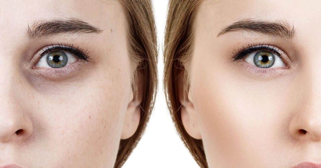 The Best Practices for Under Eye Filler Aftercare