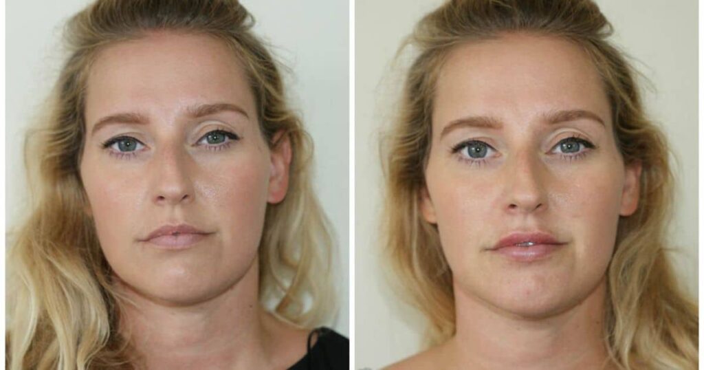 Before and After: Transformative Results of Under Eye Filler