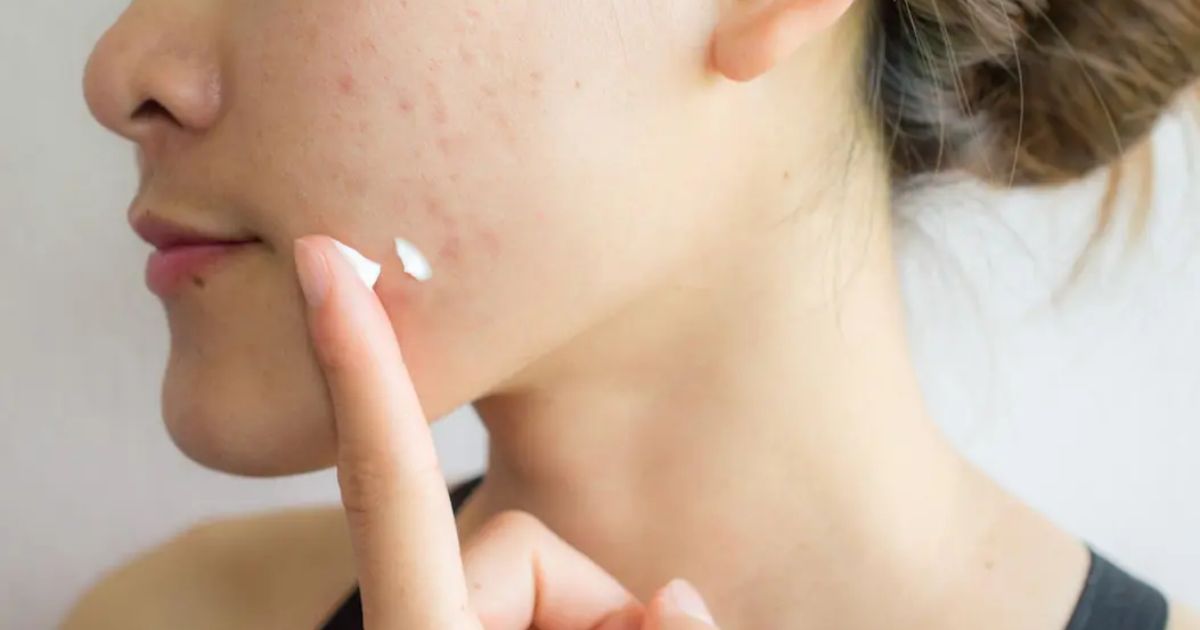 Can I Use Triamcinolone Acetonide Cream On My Face?