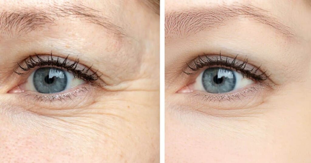 Instant Results: Seeing the Difference With Under Eye Filler