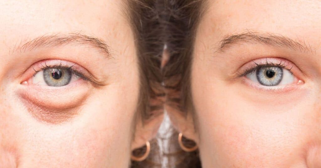 Risks and Side Effects of Under Eye Filler
