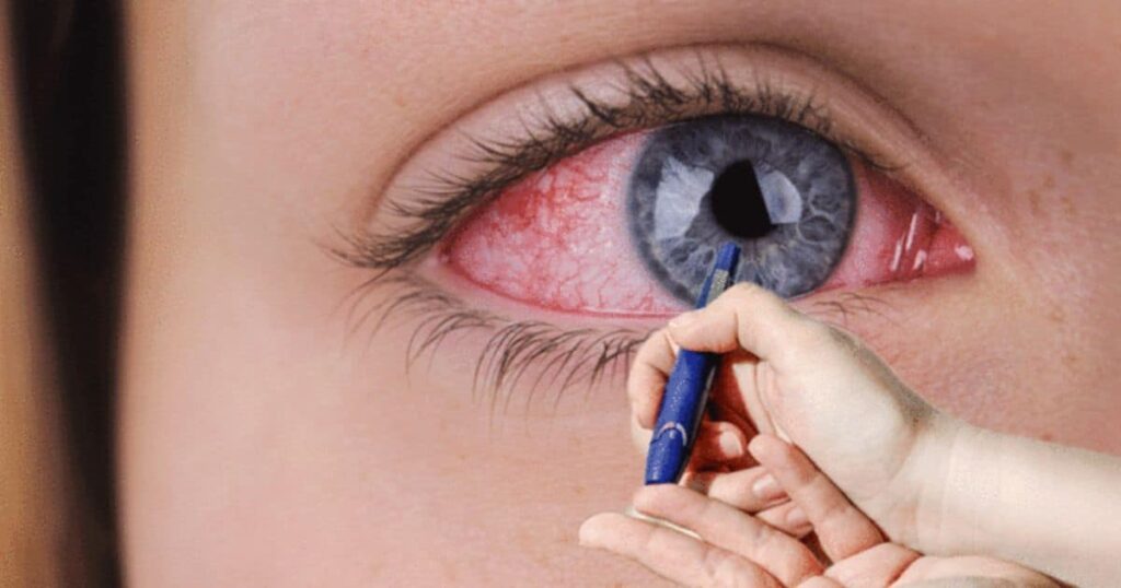 The Unsettling Reality of Needles Around Your Eyes