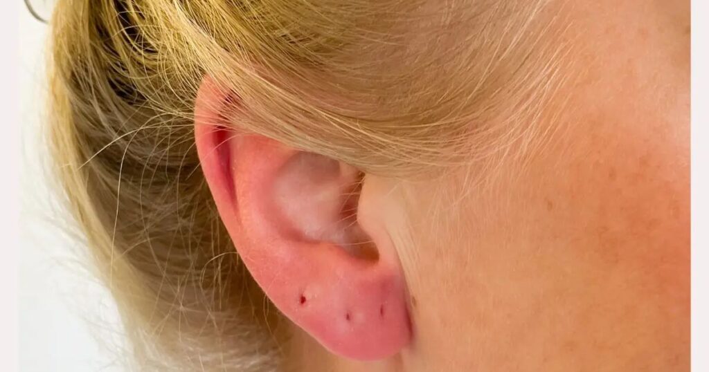 Common Causes of Bleeding After Ear Piercing